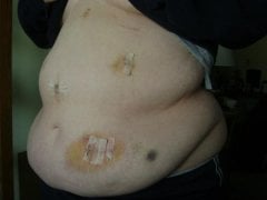 post op boo boo's