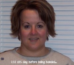 Pre-op picture my heaviest weight of 232 LBS.