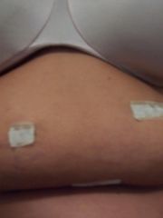 1 day after surgery