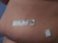 day 1 post op