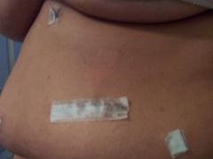 day 1 post op