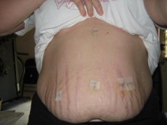 My war wounds, 6 days post op