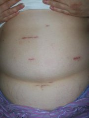 scars month 2