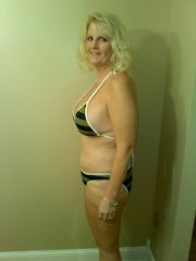12/03/09 2 weeks post op from plastic surgery.