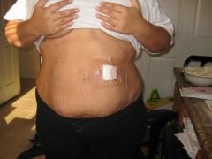 06-20-09 Day 2, my incisions