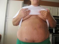 06-21-09 Day 3, my incisions