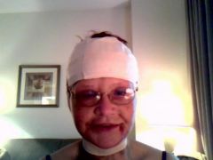 4th day (Sat. June 27th,) 2009 and feeling loads better.  Man I hope I get to keep this nose when the swelling goes down, it is exactly what my nose was like as a teen.