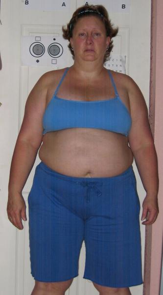 Lapband Before and After Pics