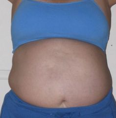 This pic 2 weeks before follow up appt. to get surgery date.
Taken June 28, 2009.