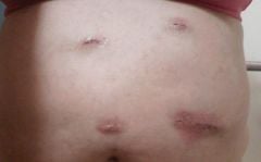 5 days Post Op