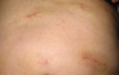3 weeks Post Op