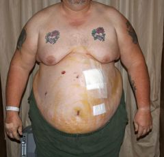2008 12 19 Before After Surgery Day 005