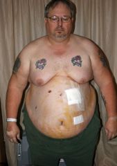 This pictures was taken the night after surgery

Day of surgery weight 359