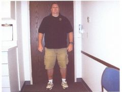 Pre op pic.  Aug. 2007