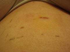 My little scar at the top.