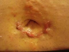 My bellybutton  incision.