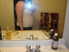 2 weeks post-op 32 lbs down 240 lbs