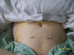a few hours after surgery 7/31/09