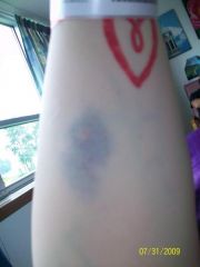 first spot they tried to get the IV in (they numb it before they do the IV, thank god!)