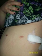this on is healing better now the one next to it is infected how do i help it?