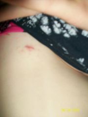 this is on my chest well near it, healing pretty good