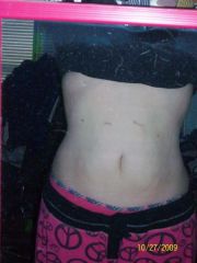 getting smaller

Waist:36.5
Chest:40.8
Hips:46.0

and 10 days before surgery (before i went on pre-op diet)those were;

Waist: 42.0
Chest: 42.5
Hips:51.2