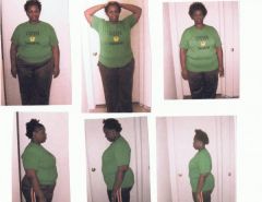 The day of surgery pic #1, 1st month 2nd month. I dont see too much of a change so I dont think Im going to post anymore pics untill I reach my 1st goal of -50lbs.