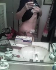 side view 4 days after mini tuck