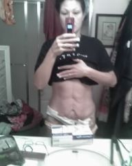 4 days after tuck...my port is sticking out like crazy and still very swollen