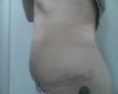 SIDE VIEW...NO MORE SKIN HANGING...FEELS AWESOME!!!!!!!!!