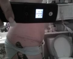 bad side...blood clot on the left side of my pelvis...oooouuuucccchhhh....very painful...3 weeks after panniculectomy and mini tuck