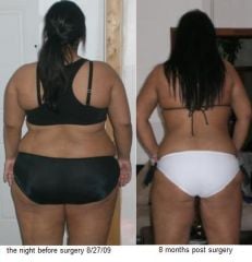8 month post op comparison pic - from behind ;)