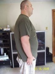 1 week post op side
314 lbs here