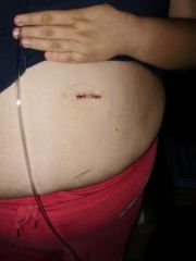 06 1d post op 08/06/2009 was lucky to only get the single incision