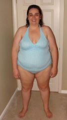 night before surgery weight 273.very hard to look at this pic