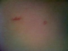 scars2