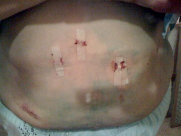 Post-op pics...
