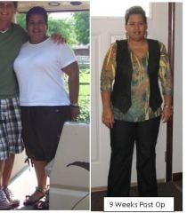 Pre-op and 9 Weeks post op.  28.5 lost.