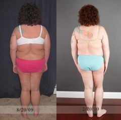 6 month post op. The only thing i like better about the left photo is that i'm tan and my toe nails are painted, lol!!