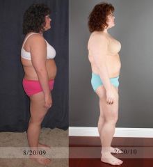 6 month post op.