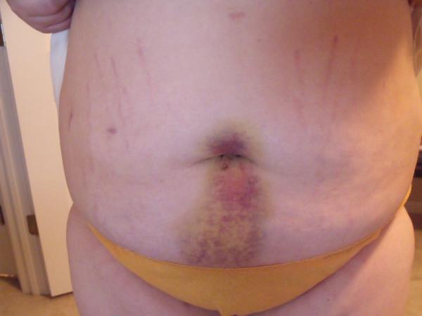 Ugly incision site