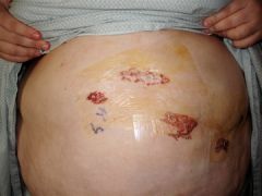 My incisions the day after surgery.