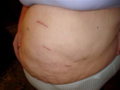 Scars: 3 months out.