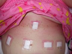 Day after surgery