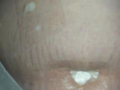 2 of 3 incisions