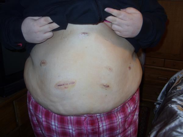 Post Op