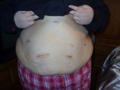 1/6/2010 Day after Surgery