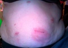3 Weeks Post op