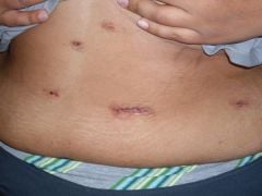 My incisions day 2
