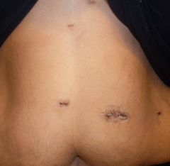 Incisions exactly 3 weeks out. Looking good!